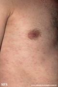 syphilis secondary