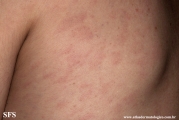 syphilis secondary