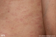 syphilis secondary