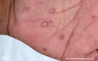 syphilis secondary