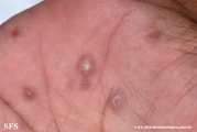 syphilis secondary