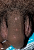 syphilis secondary