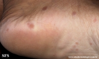 syphilis secondary