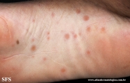 syphilis secondary