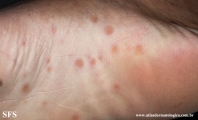 syphilis secondary