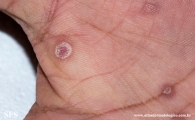 syphilis secondary