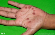 syphilis secondary