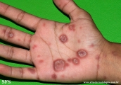 syphilis secondary