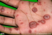 syphilis secondary