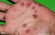 syphilis secondary