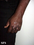 factitial dermatitis