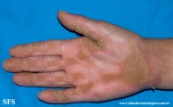 palmoplantar_keratoderma-focal_keratoderma-striate_type