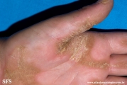 palmoplantar_keratoderma-focal_keratoderma-striate_type