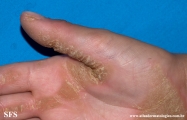 palmoplantar_keratoderma-focal_keratoderma-striate_type