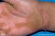 palmoplantar_keratoderma-focal_keratoderma-striate_type