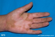 palmoplantar_keratoderma-focal_keratoderma-striate_type