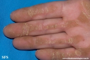 palmoplantar_keratoderma-focal_keratoderma-striate_type