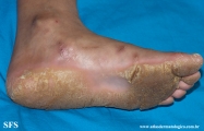 palmoplantar_keratoderma-focal_keratoderma-striate_type