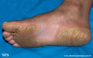 palmoplantar_keratoderma-focal_keratoderma-striate_type