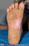 palmoplantar_keratoderma-focal_keratoderma-striate_type