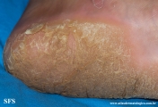 palmoplantar_keratoderma-focal_keratoderma-striate_type