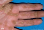 palmoplantar_keratoderma-focal_keratoderma-striate_type