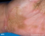 palmoplantar_keratoderma-focal_keratoderma-striate_type