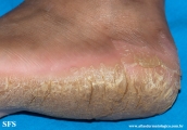 palmoplantar_keratoderma-focal_keratoderma-striate_type
