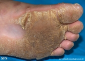 palmoplantar_keratoderma-focal_keratoderma-striate_type