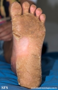 palmoplantar_keratoderma-focal_keratoderma-striate_type