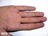 tinea manuum