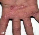 tinea manuum
