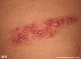 herpes zoster