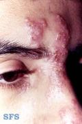 herpes zoster