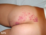 herpes zoster