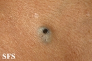 warty dyskeratoma