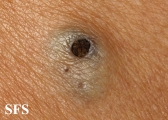 warty dyskeratoma