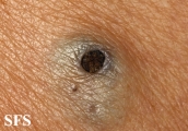 warty dyskeratoma