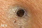 warty dyskeratoma