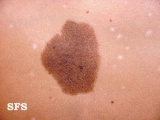 melanocytic naevi congenital