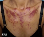 lupus erythematosus-subacute cutaneous lupus erythematosus