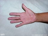 keratolysis_exfoliativa