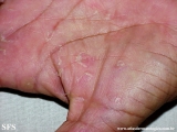 keratolysis_exfoliativa