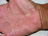 keratolysis_exfoliativa
