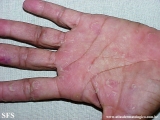 keratolysis_exfoliativa