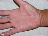keratolysis_exfoliativa