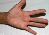keratolysis_exfoliativa