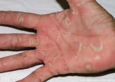 keratolysis_exfoliativa