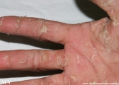 keratolysis_exfoliativa