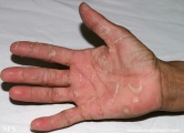 keratolysis_exfoliativa